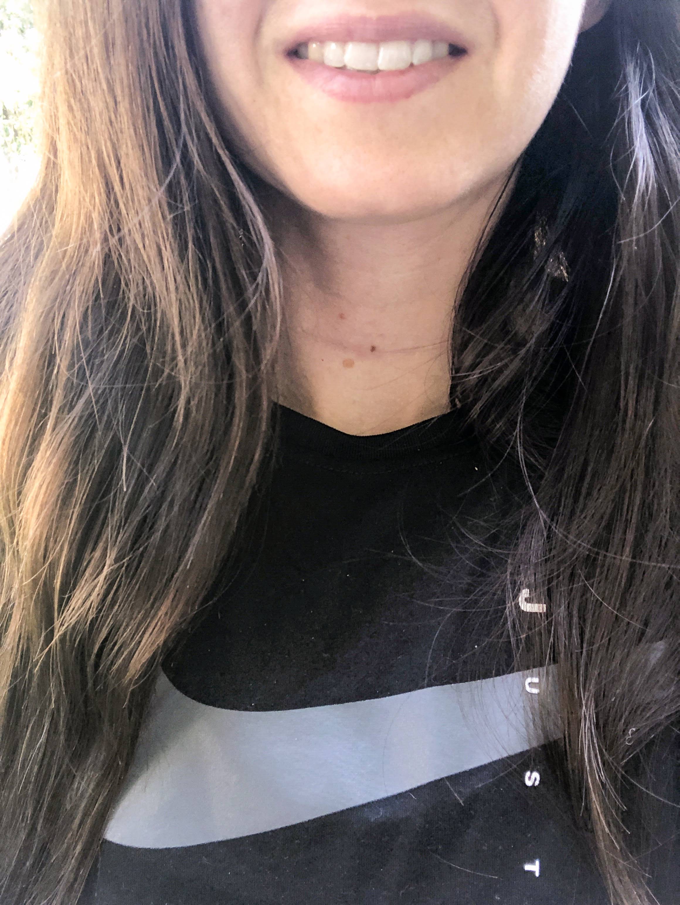 Selfie of thyroidectomy faded scar